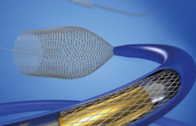 医疗卫生：最新获批！血流导向密网支架上市